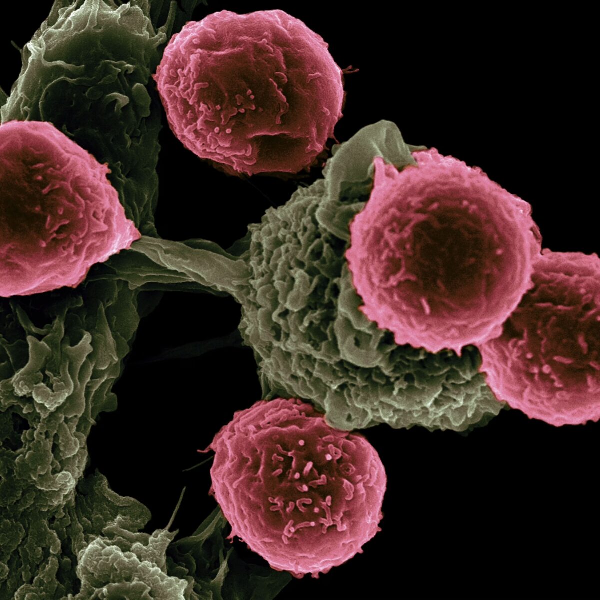 Heterogeneity in tumor microenvironment challenges therapeutic resistance of cancer cells